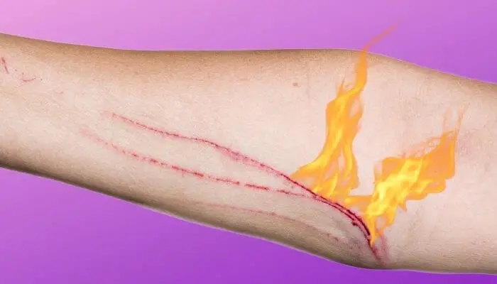 why do cat scratches burn